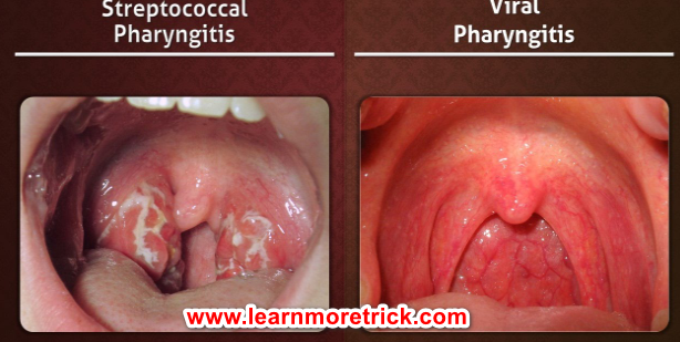  ENT-Throat infection-Pharyngitis 